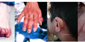 Обморожения. Основные признаки и первая помощь